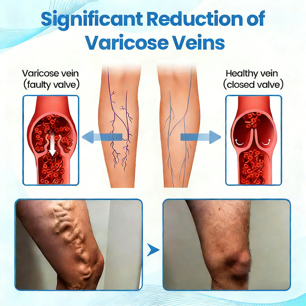 ✨💖Celsiora® Horse Chestnut Vein Repair Spray—Effectively treats varicose veins, venous insufficiency, ulcers, and thrombophlebitis. Rapidly alleviates leg aching and swelling by promoting healthy blood circulation