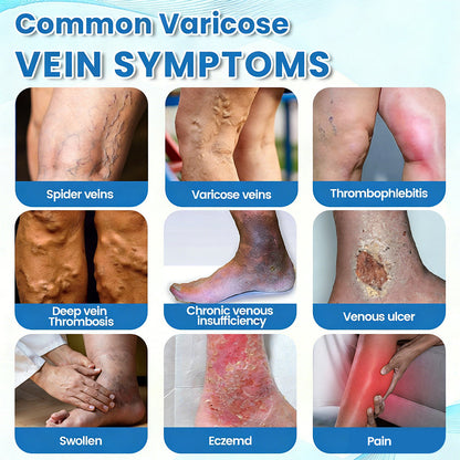 ✨💖Celsiora® Horse Chestnut Vein Repair Spray—Effectively treats varicose veins, venous insufficiency, ulcers, and thrombophlebitis. Rapidly alleviates leg aching and swelling by promoting healthy blood circulation