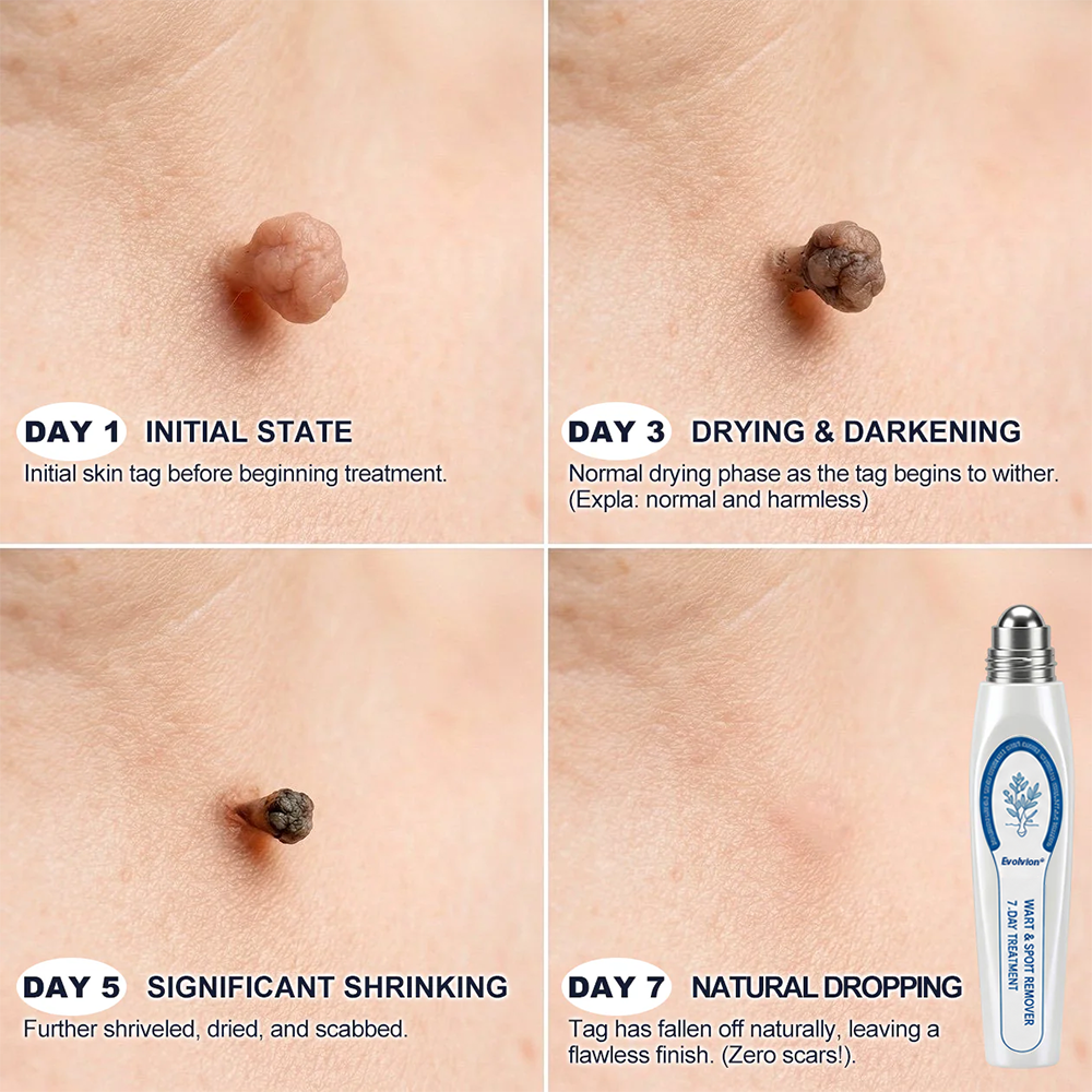 ✨💖Evolvion® 𝟕-𝐃𝒂𝘆 𝐒𝗸𝐢𝐧 𝐓𝒂𝗴 & 𝐒𝐩𝙤𝐭 𝐄𝐫𝒂𝐬𝙚𝐫 Painless & Scar-Free Advanced Imperfection Remova𝗜 Ro𝗜𝗜erba𝗜𝗜 Pen 🌿